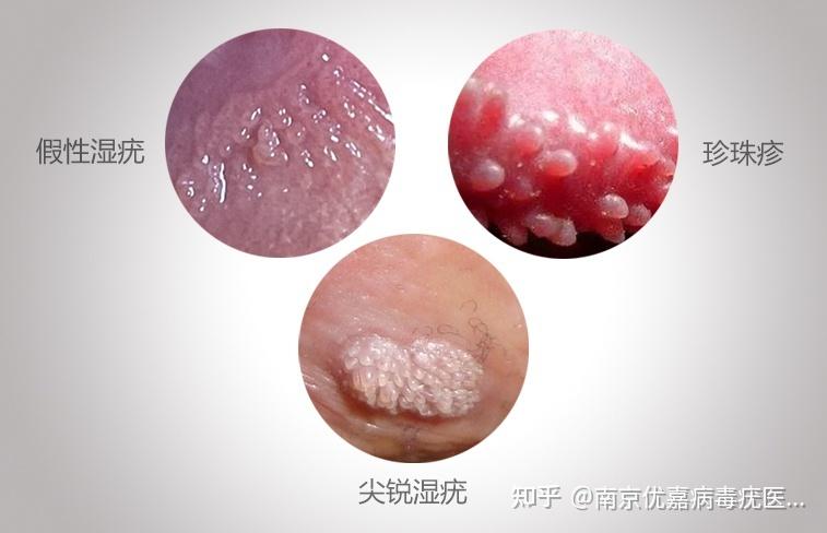 男性湿锐疣初期图片症状：小颗粒/小肉芽需警惕