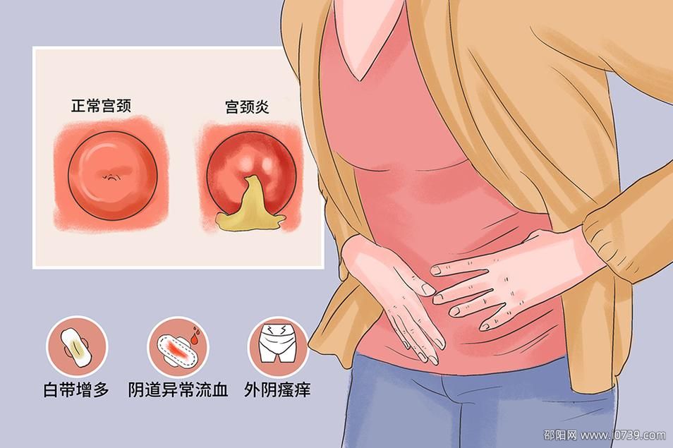 宫颈炎患者有哪些症状是最常见的