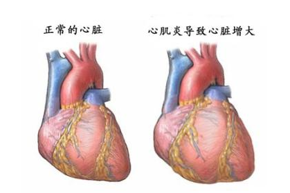 心肌炎治疗方法揭秘：了解心肌炎的病因及引起方式